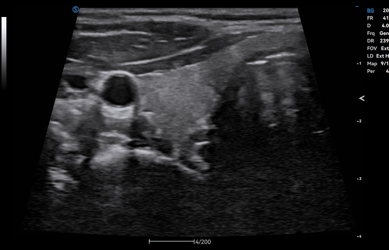 KI-Modul Auto Thyroid für SIUI Apogee C1 Exp - mobiles Ultraschallgerät