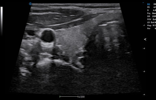 KI-Modul Auto Thyroid für SIUI Apogee C1 Exp - mobiles Ultraschallgerät